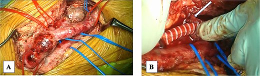 Intraoperative photograph. (A) Common femoral artery aneurysm (CFAA): (B) superficial femoral artery. (C) Profunda femoris artery aneurysm (PFAA). (B) The CFAA was replaced with a prosthetic vessel, and the PFAA was resected proximally. A branch of the lateral circumflex artery was anastomosed to the prosthetic vessel (arrow).