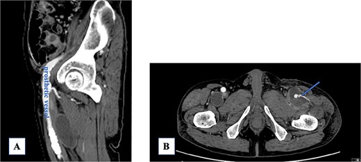 (A) Post-prosthetic vessel replacement. (B) The lateral circumflex artery is patent (arrow).