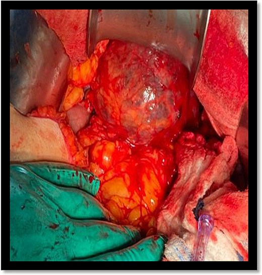 Multiseptated cystic lesion abutting the spleen and distal aspect of the pancreas.
