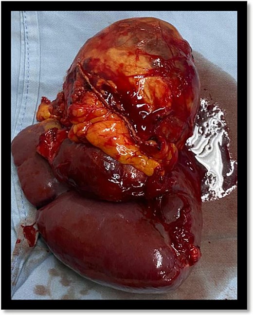 Resected spleen with multinodular cystic mass at the splenic hilum.