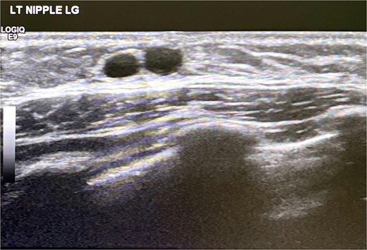 Ultrasound scan left breast showing cystic duct changes suggestive of mammary duct ectasia.