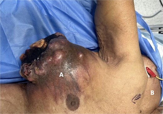 Preoperative picture. (A) Right breast mass, immobile, fungating, and ulcerating with purulent discharge. (B) Right upper back mass, soft, mobile, with normal overlying skin, suggestive of lipoma.