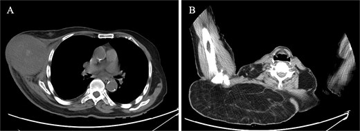 CT finding. (A) CT scan of right breast showing heterogeneous mass, measuring 8.0 × 8.7 cm, extending from the mid to the anterior axillary line. (B) CT scan of right upper back showing a large, fat-density mass, suggestive of lipoma.