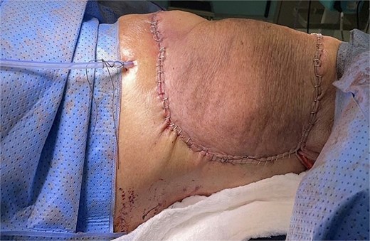 Postoperative picture. Following the right mastectomy and excision of the right upper back lipoma, a local rotational skin flap was utilized to close the surgical defect.