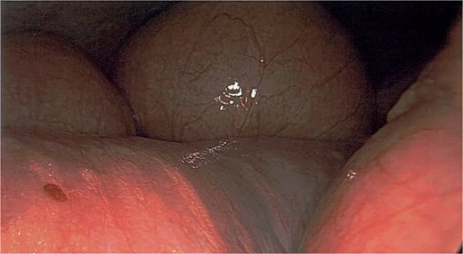 Dilated small bowel loops during laparoscopy. Visualization aided by standard laparoscope illumination.