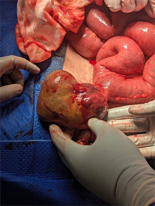 Intraoperative image of GIST arising from the antimesenteric border of jejunum, along with dilated small bowel loops.