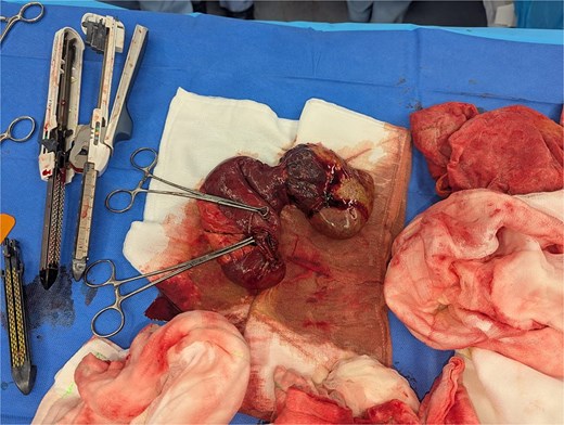 GIST following resection.