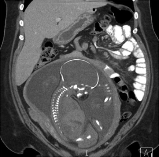 Coronal CT demonstrating left upper quadrant mesenteric swirling with cluster of small intestine entirely on the left abdomen.