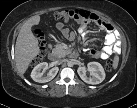 Axial CT demonstrating mesenteric swirling.