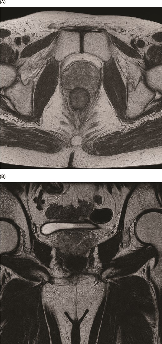 (A, B) Preoperative magnetic resonance imaging (MRI) of the prostate in T2-weighted sequence demonstrating the lesion. (A) Axial view. (B) Coronal view.