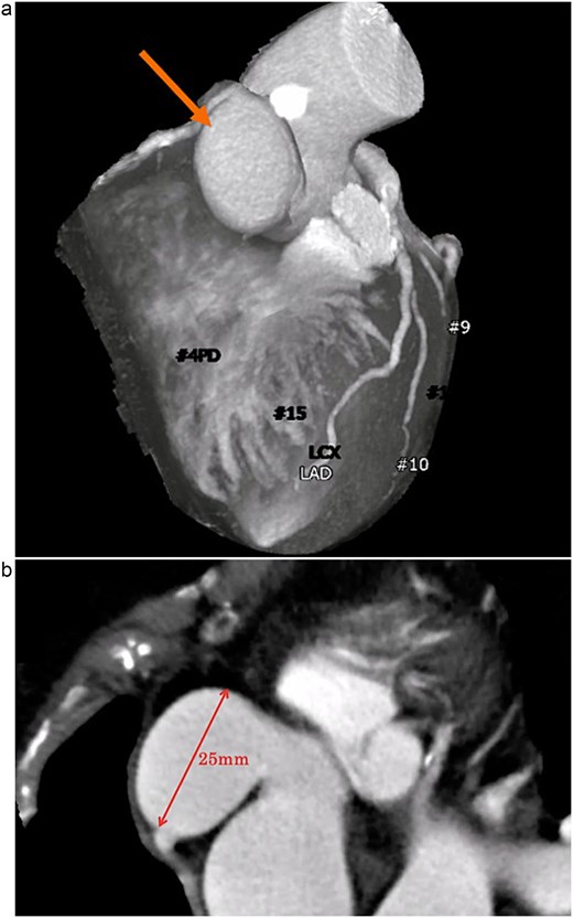 (a) Contrast-enhanced CT demonstrating a saccular aneurysm arising from the right coronary sinus of Valsalva (arrow), without evidence of significant coronary artery disease. (b) Axial contrast-enhanced CT image showing the saccular aneurysm, with a maximal diameter of 25 mm.