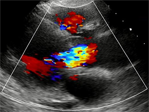TTE revealed severe AR.