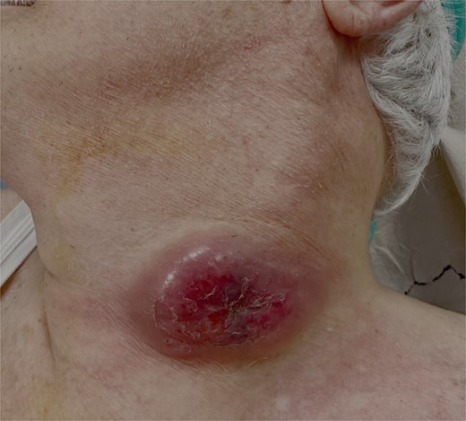 Preoperative clinical image of cervical tuberculous lymphadenitis (scrofula).