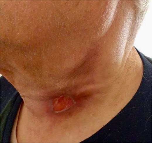 Clinical status following antituberculosis treatment.