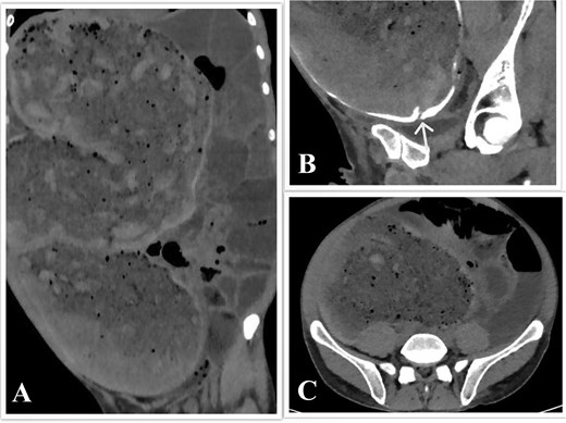 CT scan of the abdomen and pelvis. (A) Coronal view showing the megacolon and small bowel dilatation. (B) Sagittal view showing the sigmoid stricture, with the arrowhead pointing toward it. (C) Axial view showing colon dilatation at the mid-sigmoid level.