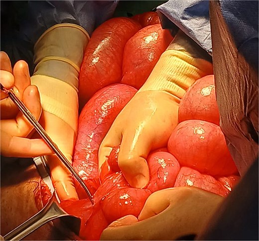 Severe small bowel distension and extensive adhesions.