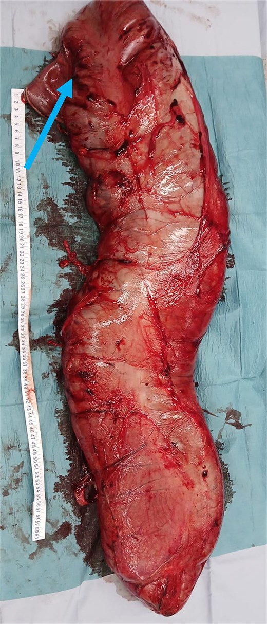 Extracted megacolon. Arrowhead pointing toward the ileocecal valve.
