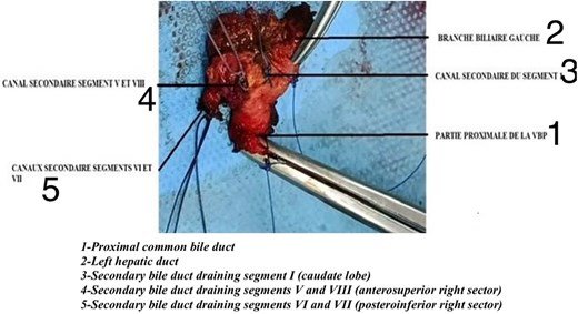 Resected specimen, 1. Proximal common bile duct/2. Left hepatic duct/3. Secondary bile duct draining segment I (caudate lobe)/4. Secondary bile duct draining segments V and VIII (anterosuperior right sector)/5. Secondary bile duct draining segments VI and VII (posteroinferior right sector).