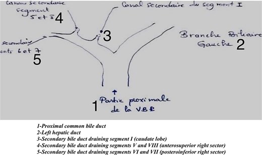 Illustrative figure of the resected specimen, 1. Proximal common bile duct/2. Left hepatic duct/3. Secondary bile duct draining segment I (caudate lobe)/4. Secondary bile duct draining segments V and VIII (anterosuperior right sector)/5. Secondary bile duct draining segments VI and VII (posteroinferior right sector).