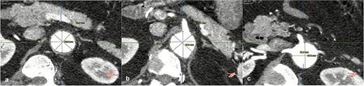 Contrast-enhanced thoraco-abdominal computed tomography (CT) with IVD at superior mesenteric artery level (a), celiac trunk level (b), renal arteries level (c).
