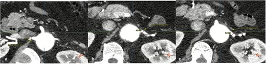 Contrast-enhanced thoraco-abdominal CT with dimensions of principal right renal artery (a), most superior left renal artery (b), most inferior left renal artery (c).