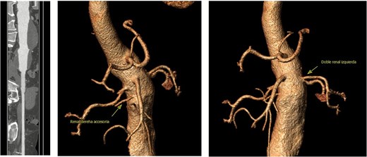 Contrast-enhanced thoraco-abdominal CT scan and angio computed tomography (CTA).