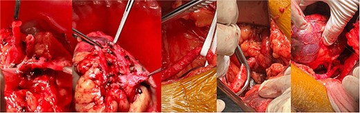 Intraoperative view showing bilateral renal arteries and vein reimplantation to the external iliac arteries.
