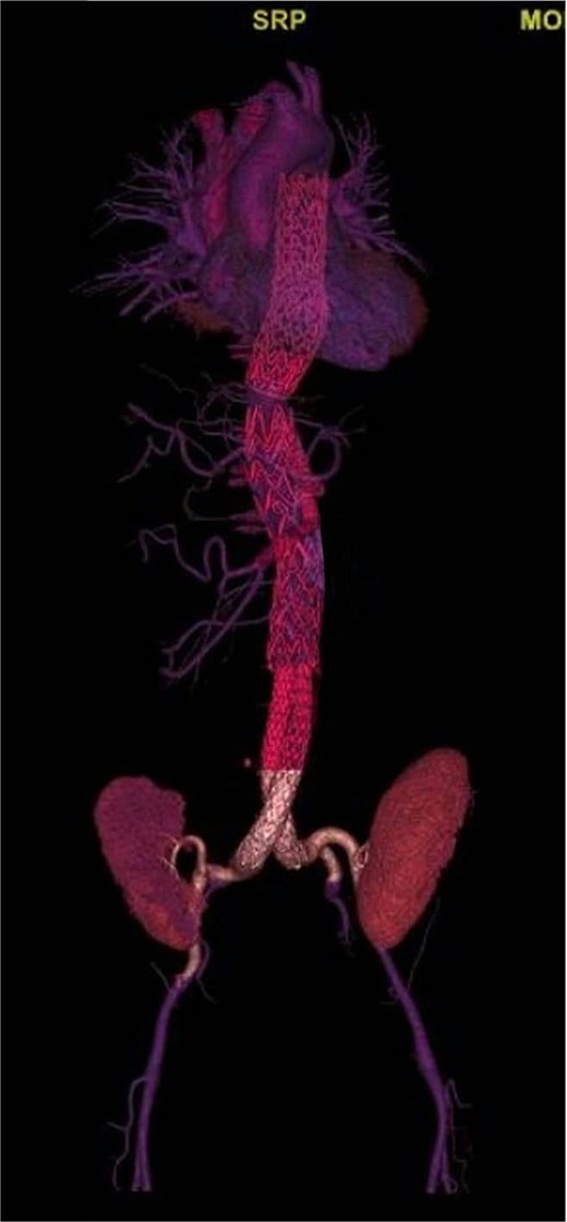 Postoperative three-dimensional CTA reconstruction showing complete exclusion of the aortoiliac aneurysmal sac after endovascular repair. The endograft extends from the distal descending thoracic aorta to the bilateral common iliac arteries, with proper device expansion and preserved distal perfusion.