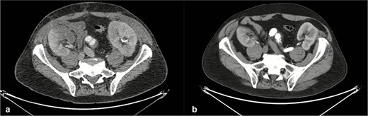 Axial computed tomography images of the thoracoabdominal region obtained before (a) and after (b) endovascular aortic repair. Postoperative imaging demonstrates patent renal arteries with preserved bilateral renal enhancement, consistent with maintained renal perfusion and function.