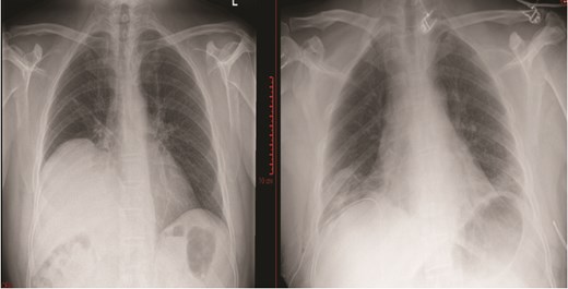 Chest X-ray prior to diaphragmatic plication (left); chest X-ray post diaphragmatic plication (right).