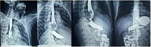 Esophagogastroduodenal series: Radiolucent image in the distal third of the esophagus forming a convex mass due to partial obstruction of the passage of contrast into the stomach.