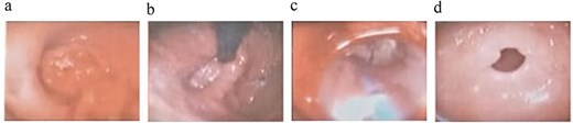 Endoscopic findings: (a) esophageal lesion; (b) hiatal hernia; (c) esophageal dilations; (d) gastric antrum.