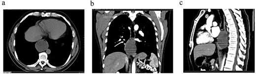 Contrast-enhanced thoracoabdominopelvic CT scan: (a) axial section showing an oval intraesophageal mass; (b) coronal section illustrating the longitudinal extent of the tumor; (c) sagittal section showing a tumor apparently respecting the pericardium.