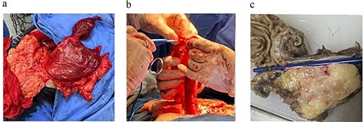 (a) Surgical specimen following transhiatal esophagectomy showing a large esophageal tumor mass. (b) Gastric tube formation for posterior mediastinal ascent. (c) Sectioned specimen displaying a well-defined, lobulated, firm mass.
