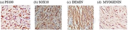 Immunohistochemical staining of the esophageal neoplasm: Positive expression of S100 (a) and SOX10 (b) consistent with neural differentiation, and co-expression of desmin (c) and myogenin (d) indicating muscle differentiation.