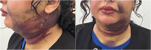 Left lateral and frontal views showing diffuse ecchymosis and swelling in the submental and anterior neck regions extending to the upper chest, four days after submental liposuction.