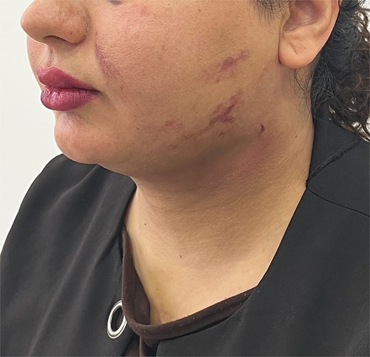 Resolution of swelling and marked reduction of ecchymosis by day 10 post-treatment.