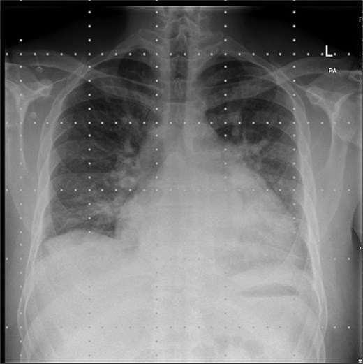 Pre-operative chest radiograph.