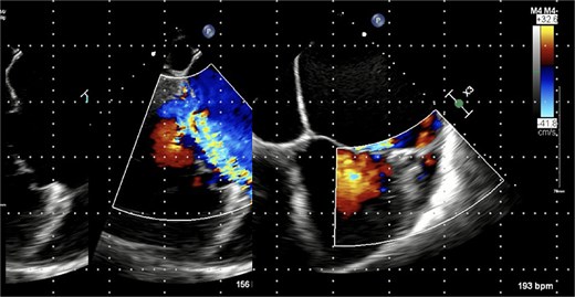 Pre-operative trans-oesophageal echocardiogram (TOE).