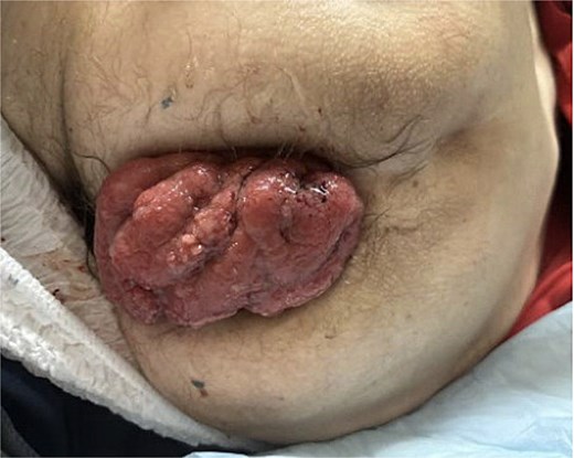 Rectal prolapse. Photograph showing prolapsed rectum and external hemorrhoids observed during physician exam on admission.