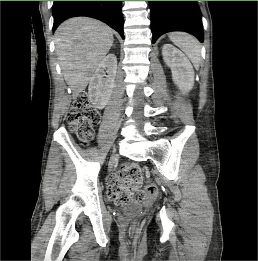 CT scan of the rectal prolapse. CT of abdomen and pelvis revealed a large rectal prolapse with extensive hemorrhoids and perirectal edema.
