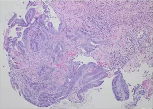 Pathology slide of rectal biopsy. Pathology of rectal biopsy demonstrating tubulovillous adenoma with focal high-grade dysplasia.