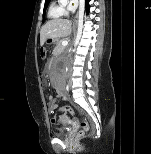 Venous phase coronal plane CECT of the abdomen and pelvis demonstrates a large right-sided retroperitoneal hematoma with a central cystic structure, consistent with a gestational sac. A focus of contrast extravasation is visible medial to the sac. The * symbol denotes blood tracing along the ovarian vessels toward the right pelvic wall, also seen on surgery.