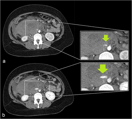 A growing slit-like focus of active extravasation was detected on arterial (a) and venous (b) phase scans, obtained 30 and 70 seconds after contrast injection, respectively.