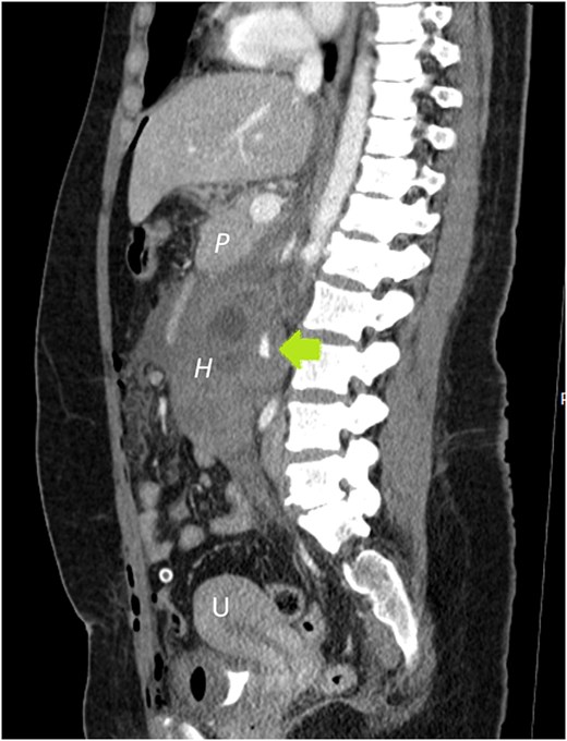 Sagittal plane CECT shows the hematoma (H) displacing the pancreas ventrally, proving its retroperitoneal location. Active bleeding is seen adjacent to the gestational sac (arrow). A normal appearing, nonpregnant uterus is also visible.