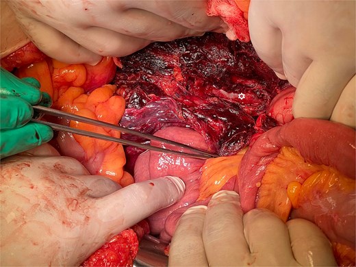 The lesion bed in the retroperitoneal space after hematoma extirpation.