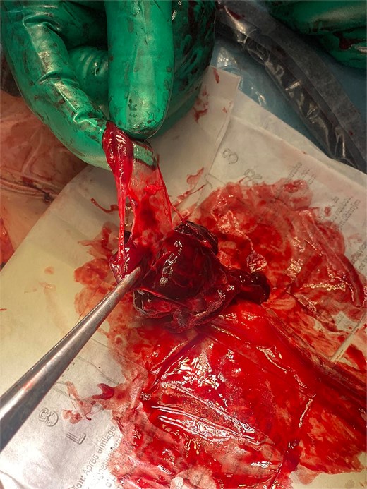 The image displays the membranous structure extracted from the bed, histologically confirmed to represent the gestational sac.