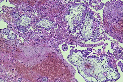 Hematoxylin and eosin stain, high-power magnification (400×) of the surgical material, demonstrating blood, fibrin, and chorionic villi.