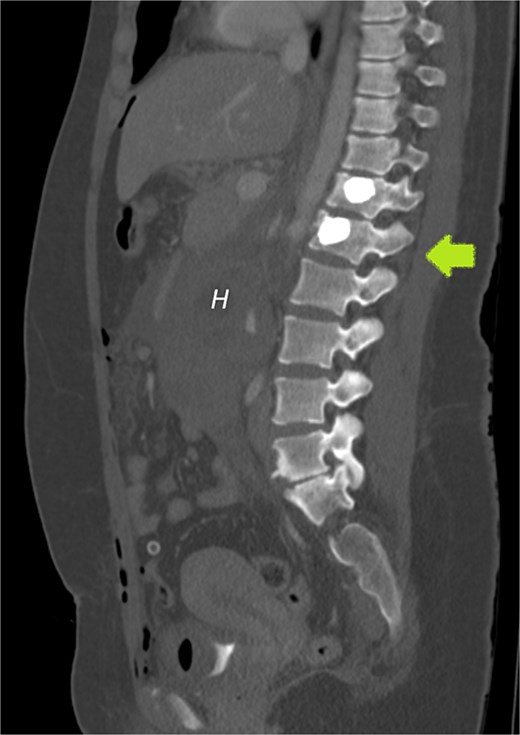 CECT of the abdomen and pelvis in the sagittal plane, bone window. Gestational sac (H for hematoma) was implanted just inferior to the level of a previous traumatic L1 vertebral fracture (arrow).