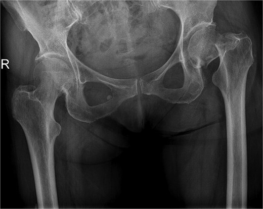 X-ray pelvis showing acute displaced and impacted left femoral transcervical fracture.